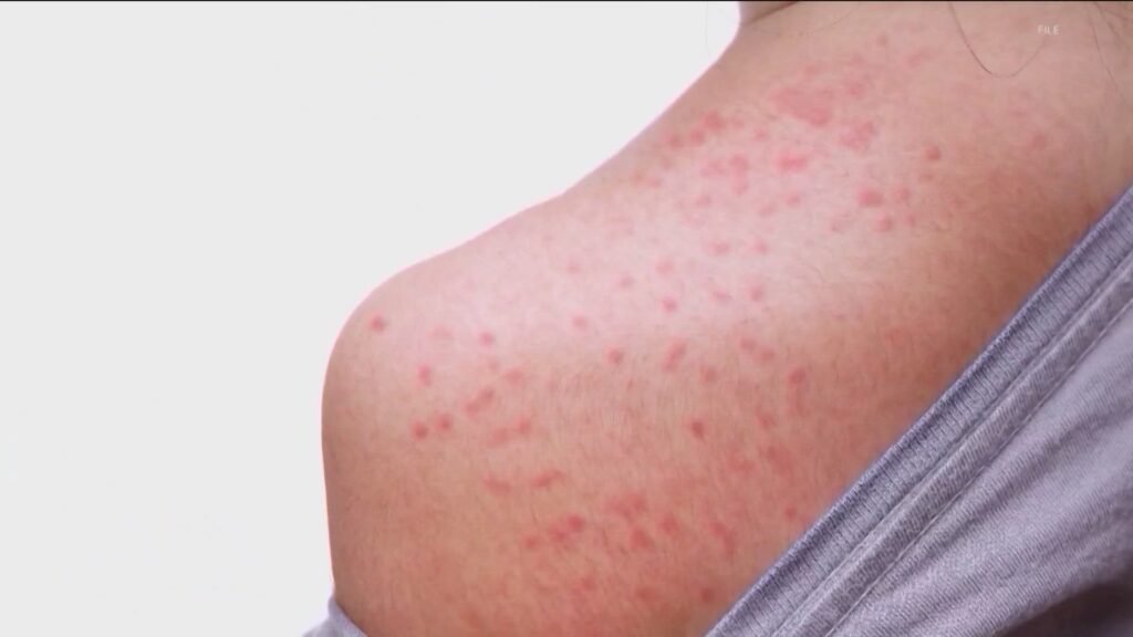 U.S. measles outbreak