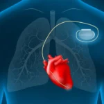 AI pacemaker chip