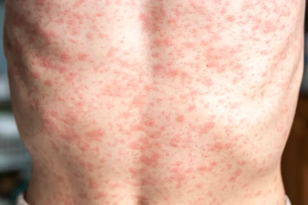 Measles outbreak in US