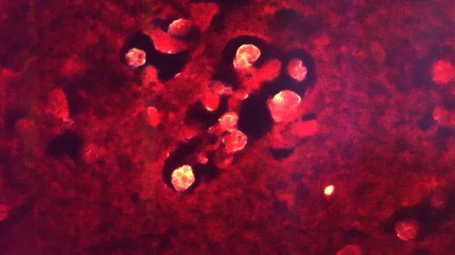 Brain-eating amoeba South Carolina