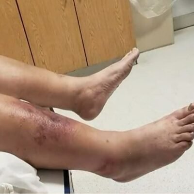 Flesh-eating bacteria Gulf Coast