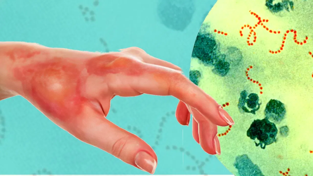 Flesh‑Eating Bacteria