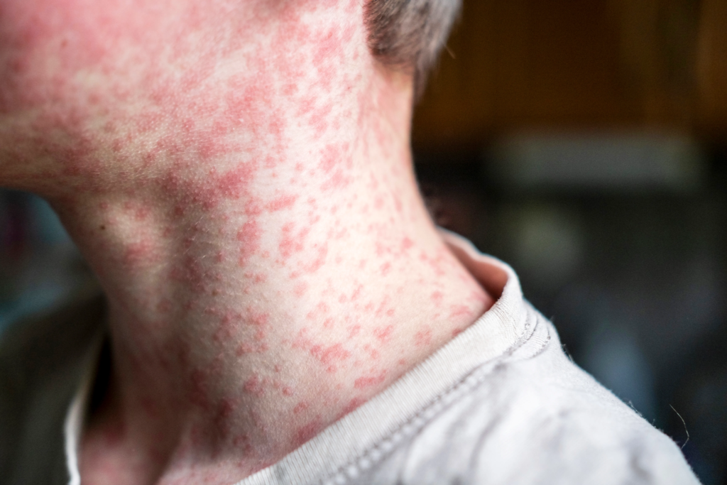 Texas measles outbreak